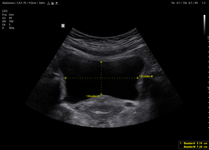 bladder