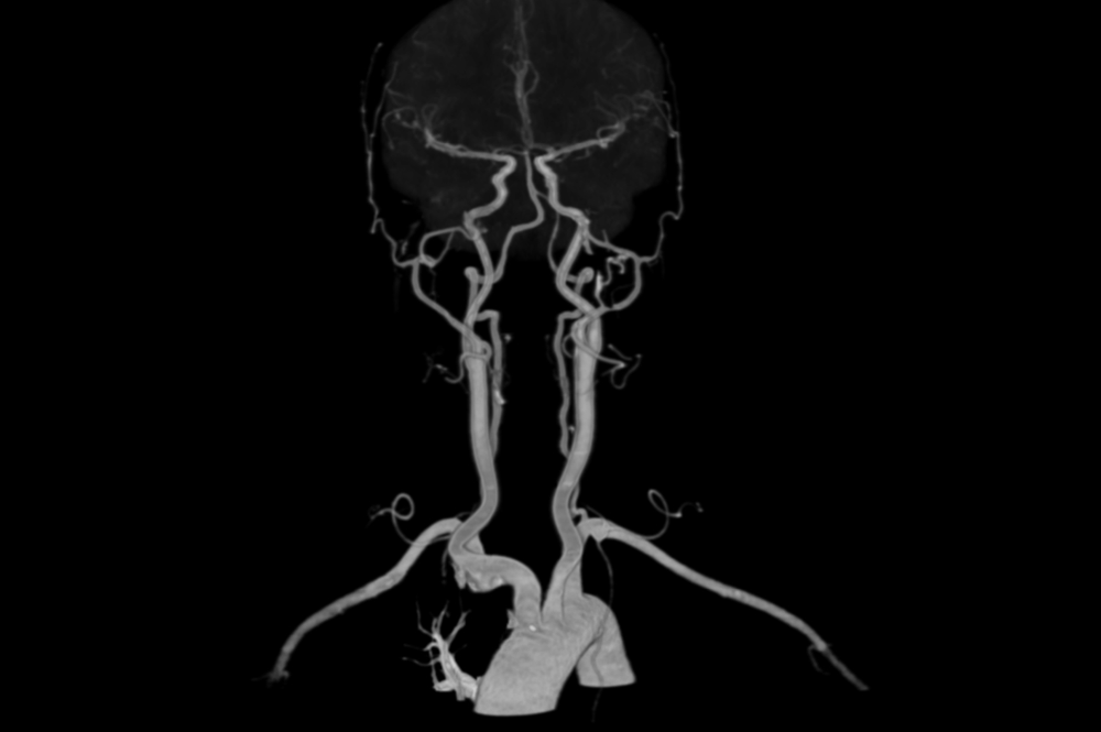 carotid-cta