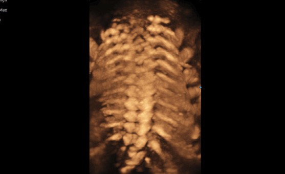 fetal spine 3D